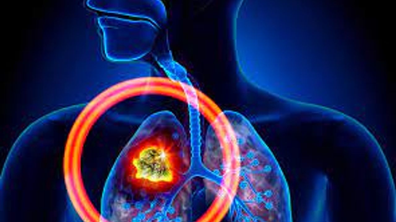 Akciğer Kanseri Nedir? Belirtileri Nelerdir? Akciğer Kanseri Tedavisi