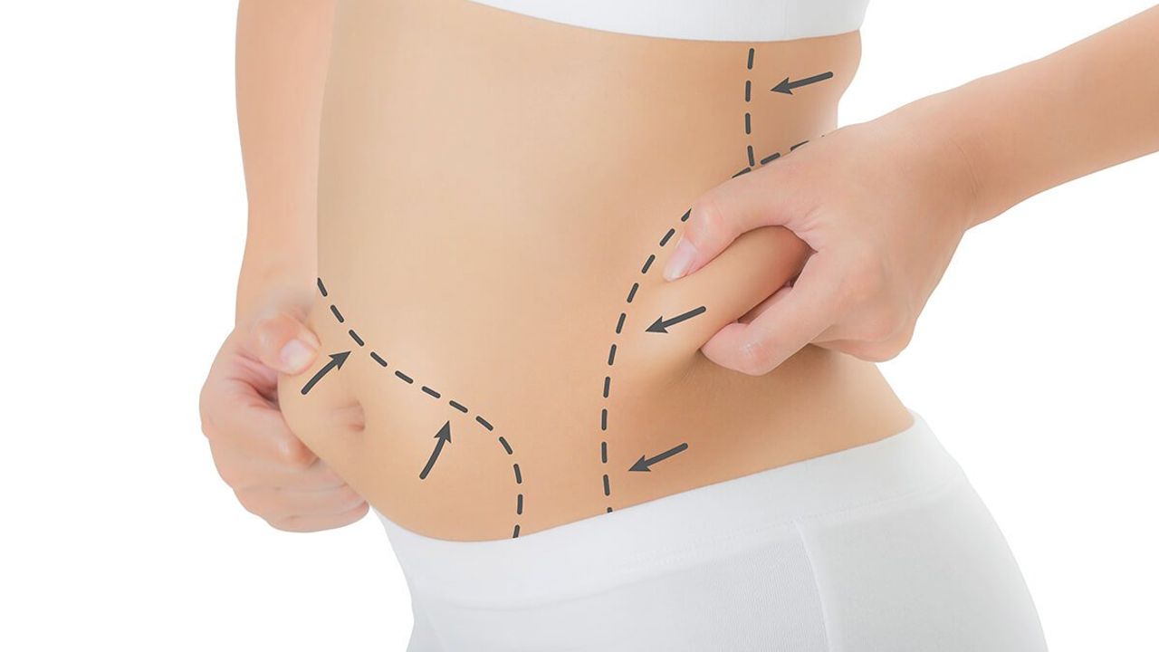 Liposuction ameliyatı için ideal hasta kimdir?