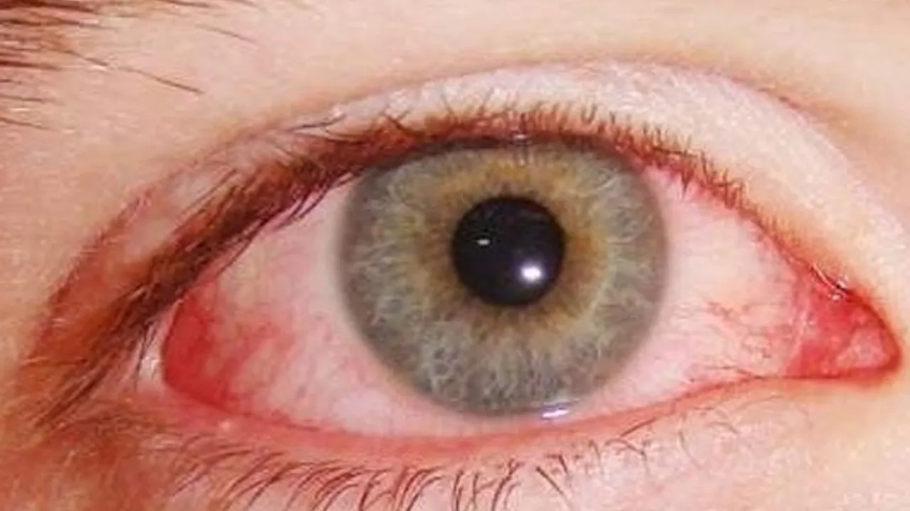 Kışla birlikte gelen göz enfeksiyonlarına dikkat