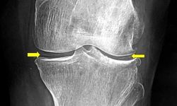 Diz kireçlenmesi o yaştan sonra daha sık görülüyor