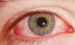 Kışla birlikte gelen göz enfeksiyonlarına dikkat