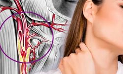 Uzmanından uyarı: "Şah damarı darlığı felç ihtimalini arttırıyor"