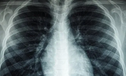 Basit gibi görünen semptomlar, kanserin habercisi olabilir