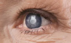 Uzmanı uyardı: "Dünya çapında 17 milyon kişi katarakt nedeniyle körlük yaşıyor"
