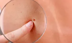 Ciltte beliren kırmızı benlere dikkat