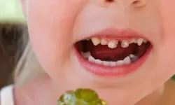 Çocukların Çoğu Erken Yaşta Diş Çürüğüyle Tanışıyor