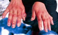 Kış mevsiminin korkulu rüyası: Soğuk ısırması