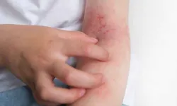 3 Yıldır Bitmeyen Uyuz Vakaları Endişe Veriyor