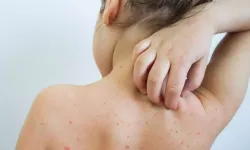 Uzmanından suçiçeği uyarısı!