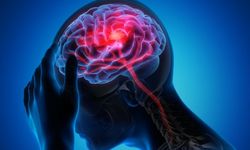 Beyin sisi başka bir hastalığın habercisi olabilir