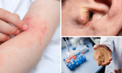 Ölüm oranı yüzde 50'den fazla! İlaçların etki etmediği mantarın vakaları hızla artıyor