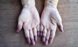 El ve ayaklarda ani mavi-mor renk değişimlerine dikkat!