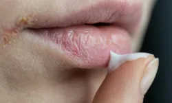 Ağız kuruluğu, ciddi bir sistemik hastalığın habercisi olabilir