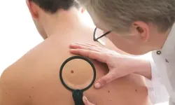 Derideki masum görünen benlere dikkat