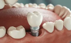 Uzmanından, implant tedavisine geç kalmayın uyarısı