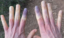 Soğukta oluşan morarma neye işaret ediyor?