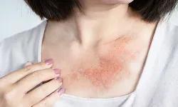 Uzmanı uyardı: Baharda cilt hastalıkları artıyor