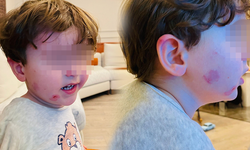 Bursa Gemlik'te kreşe bıraktığı çocuğunu darp edilmiş halde aldı