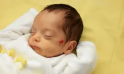 Çocuklarda hemanjioma dikkat: Erken takip önem taşıyor
