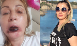 Estetik işlem sonrası dudağı çürüdü, 7 yıldır hukuk mücadelesi veriyor