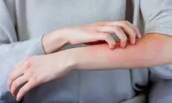 Yaz aylarında sık görülen bir cilt sorunu isilik
