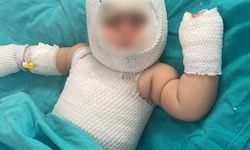 Patlayan domates konservesi 9 aylık bebeği yaktı!