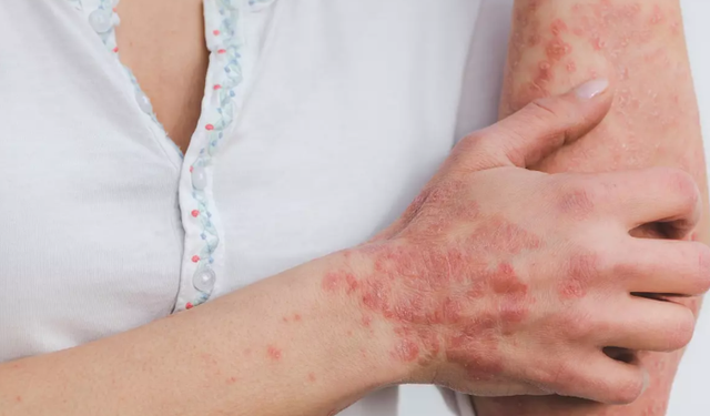 Lupus Nedir? Lupus Hastalığı Ölümcül Müdür? – Tüm Detaylarıyla