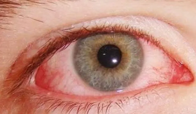 Kışla birlikte gelen göz enfeksiyonlarına dikkat