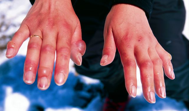 Kış mevsiminin korkulu rüyası: Soğuk ısırması