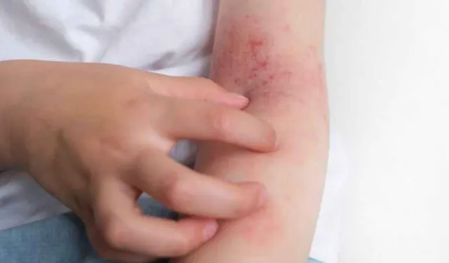 3 Yıldır Bitmeyen Uyuz Vakaları Endişe Veriyor