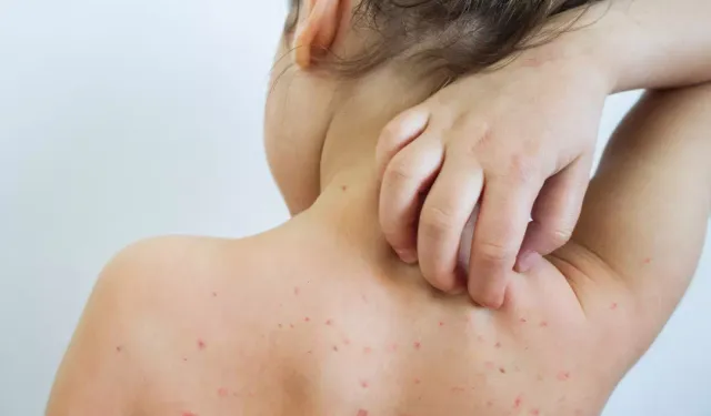 Uzmanından suçiçeği uyarısı!