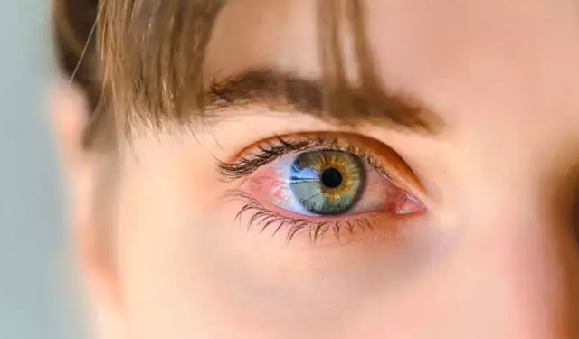 Uzmanından uyarı: "Üveit tedavi edilmezse körlüğe yol açar"