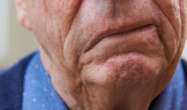 İnme riskini azaltmak için stent uygulaması yapıldı