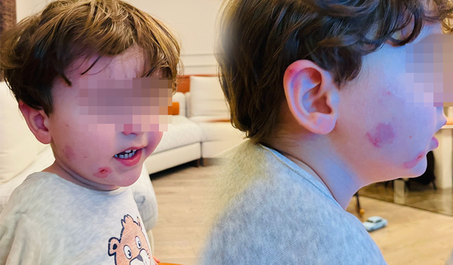 Bursa Gemlik'te kreşe bıraktığı çocuğunu darp edilmiş halde aldı