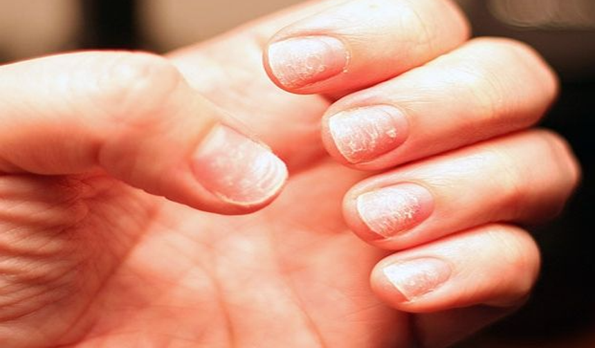 Demir Eksikliği Anemisi Nedir, Belirtileri Nelerdir? – Rehber