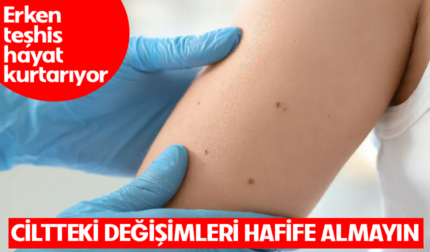 Ciltteki değişimleri hafife almayın: Erken teşhis hayat kurtarıyor