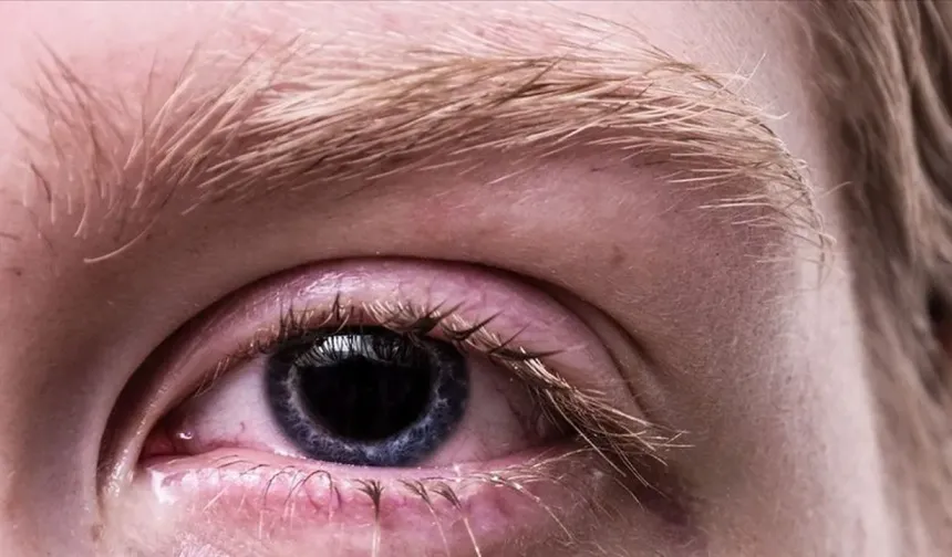 Sürekli gözünüz kaşınıyorsa dikkat: Kirpik dibi paraziti olabilir