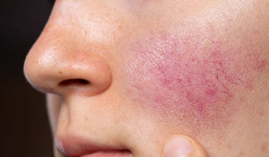 Roza, yüzde kalıcı kızarıklığa neden oluyor