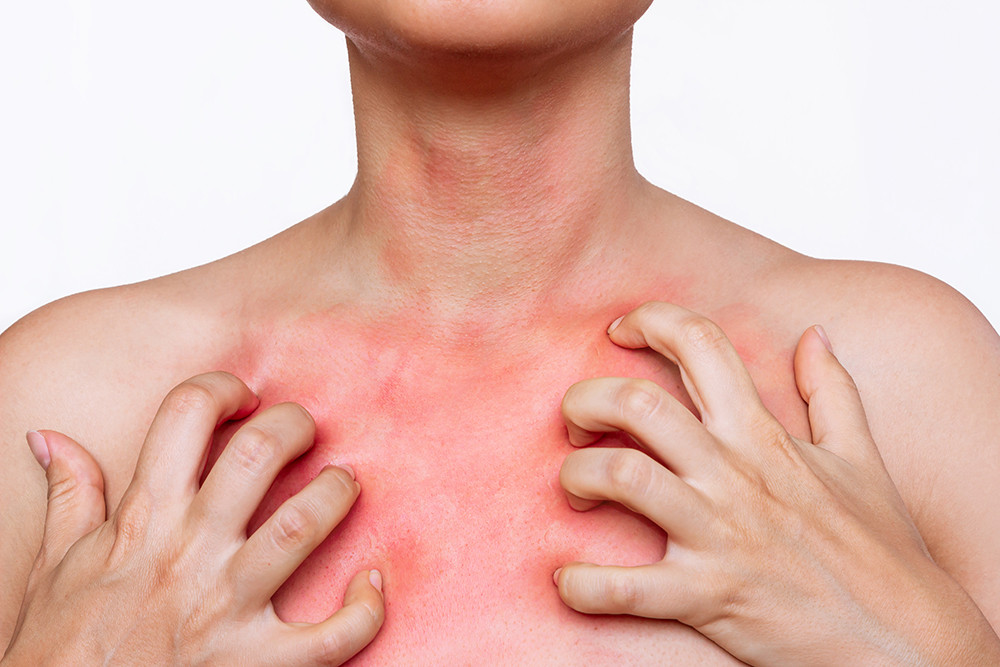 Cropped Shot Young Woman With Red Allergic Rash Her Chest Scratches Skin With Her Hands