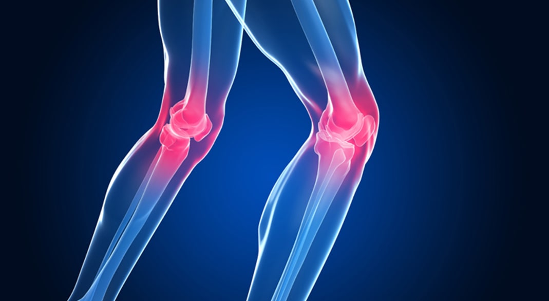 Diz Kireclenmesi Osteoartrit